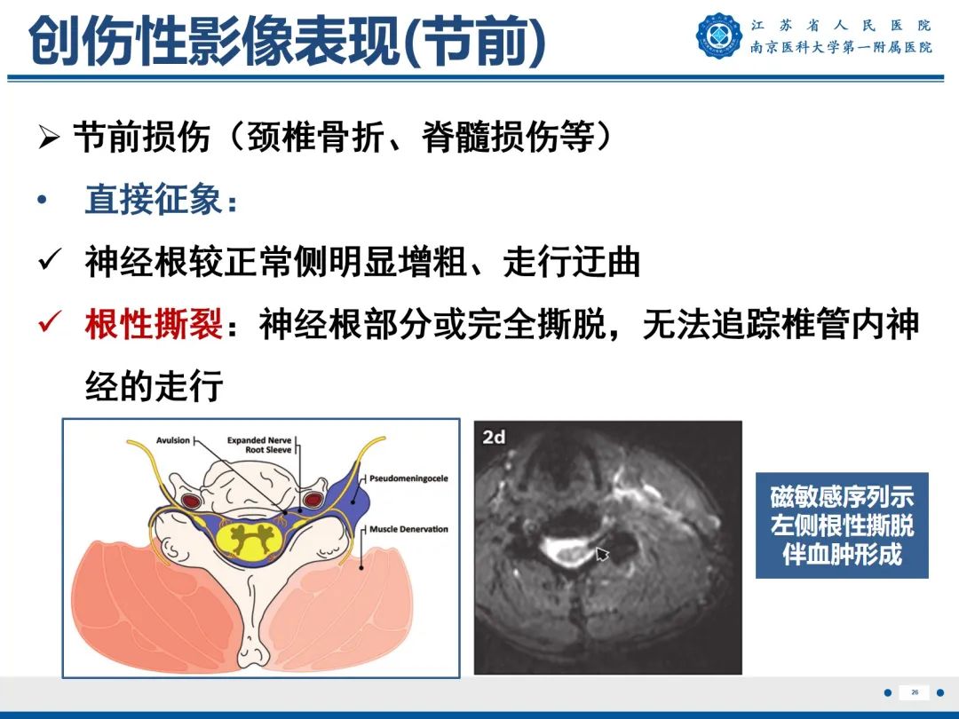 【PPT】臂丛病变-27