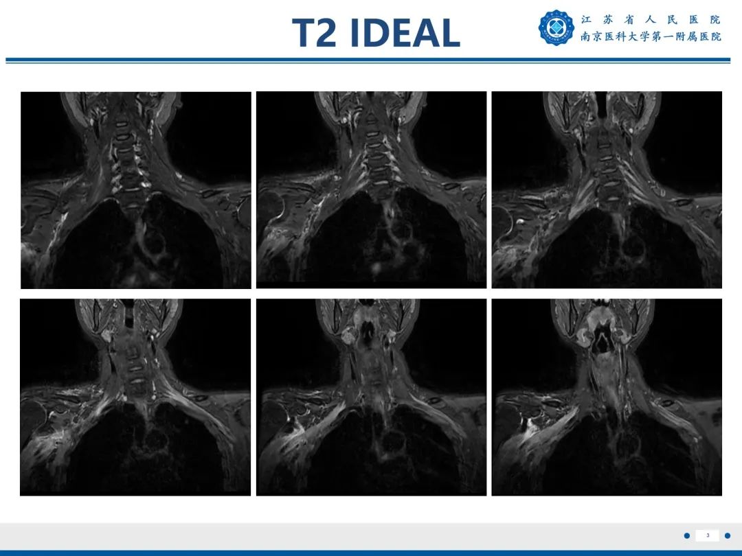【PPT】臂丛病变-4