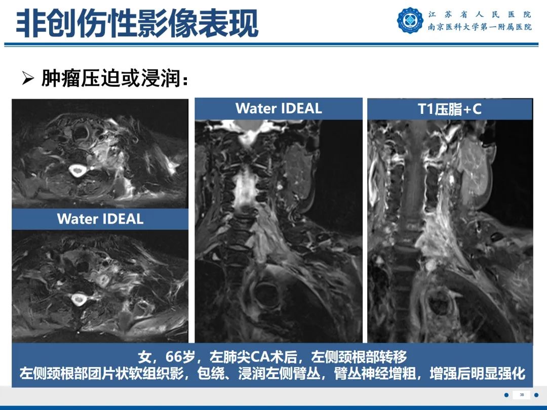 【PPT】臂丛病变-39