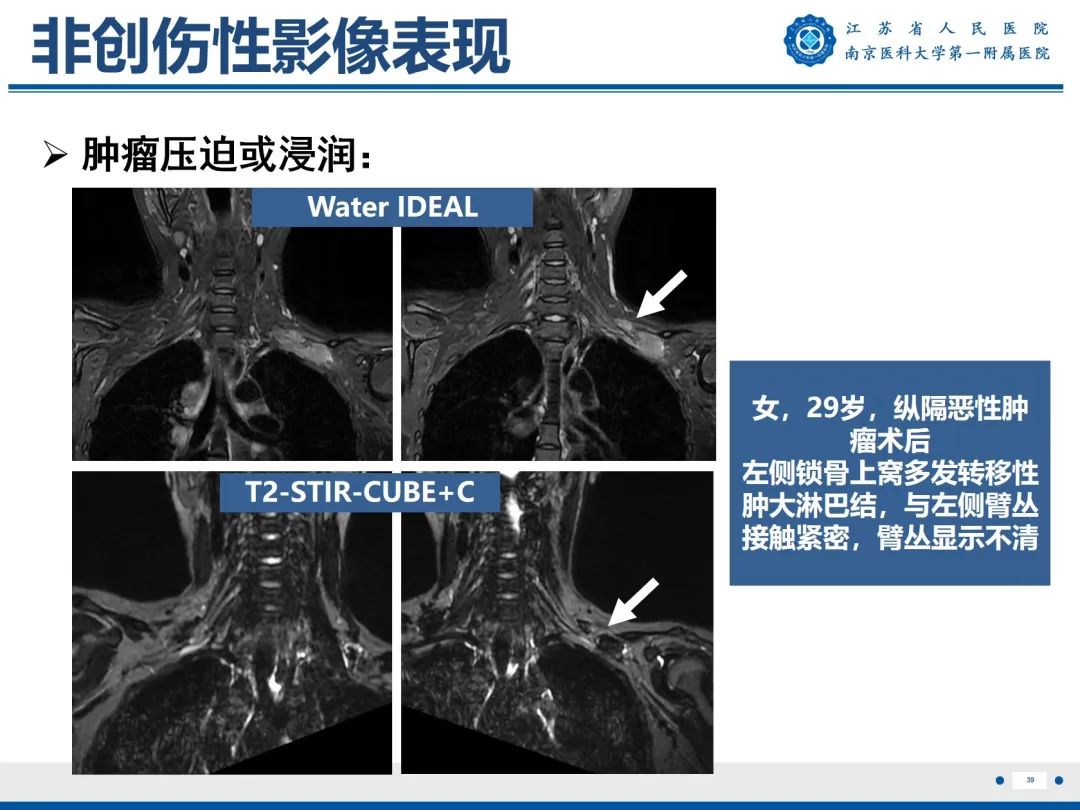 【PPT】臂丛病变-40