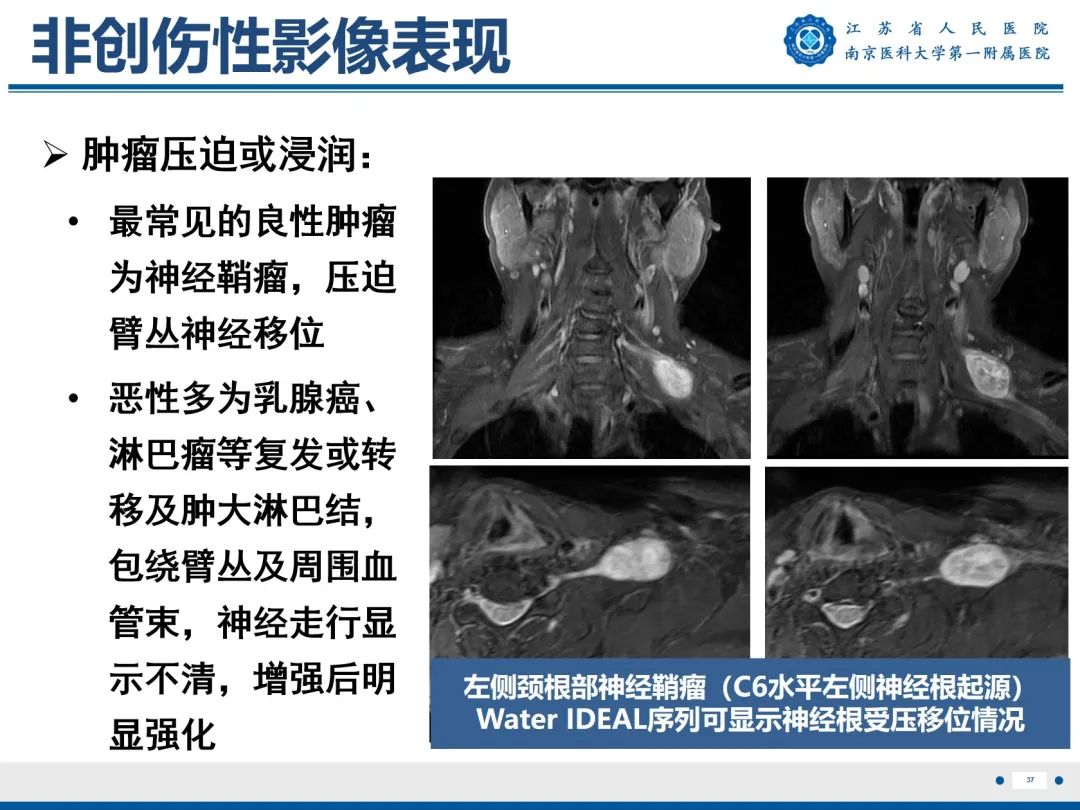 【PPT】臂丛病变-38