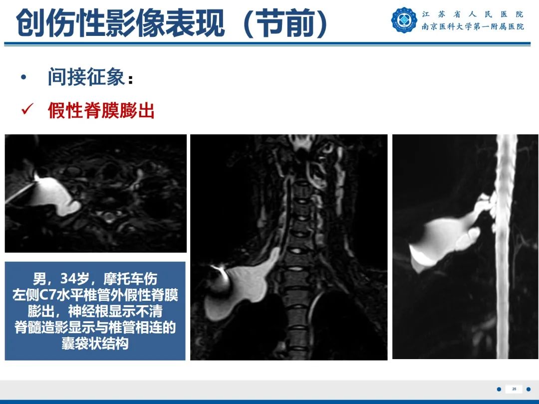 【PPT】臂丛病变-29