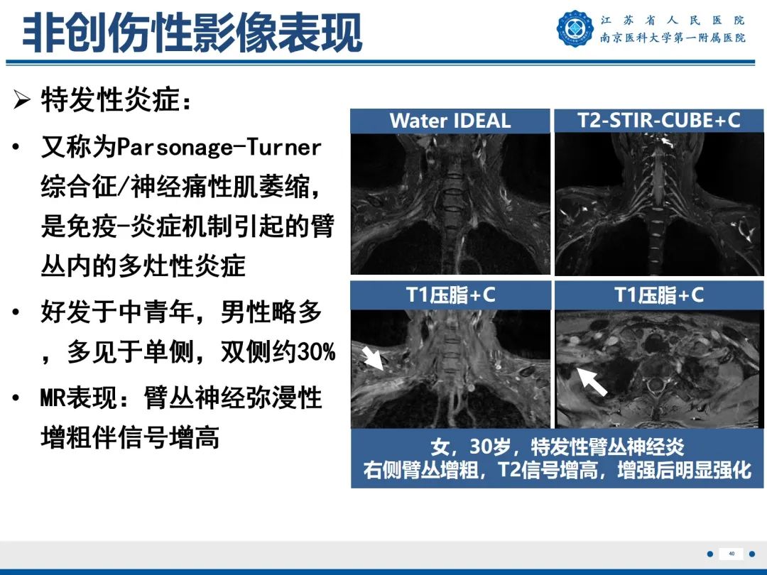 【PPT】臂丛病变-41