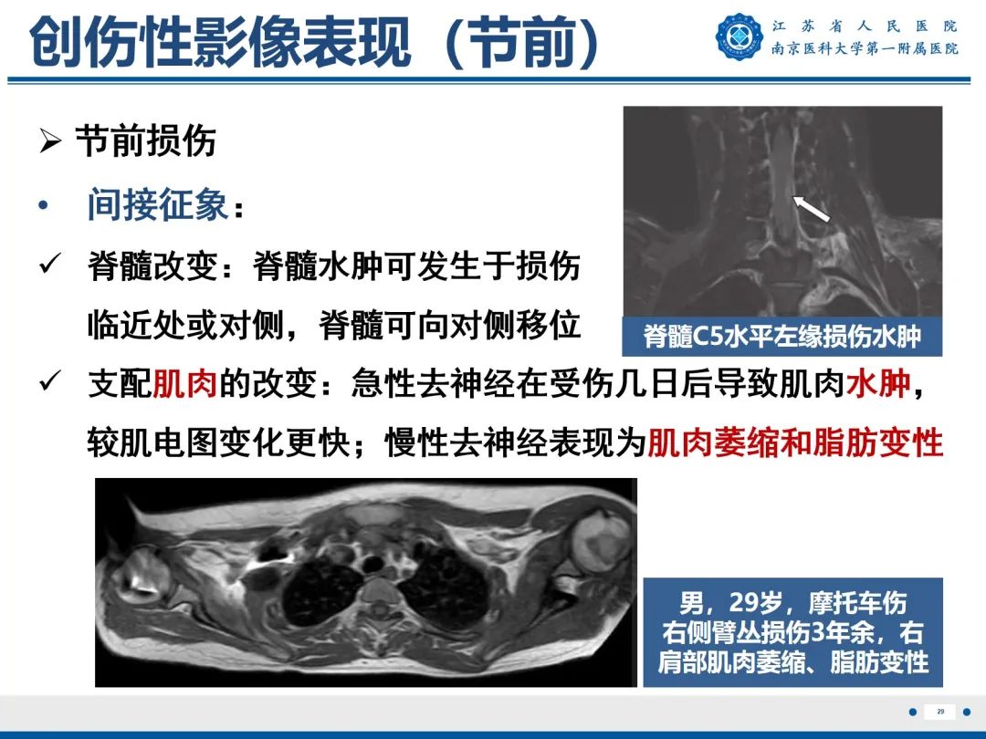 【PPT】臂丛病变-30