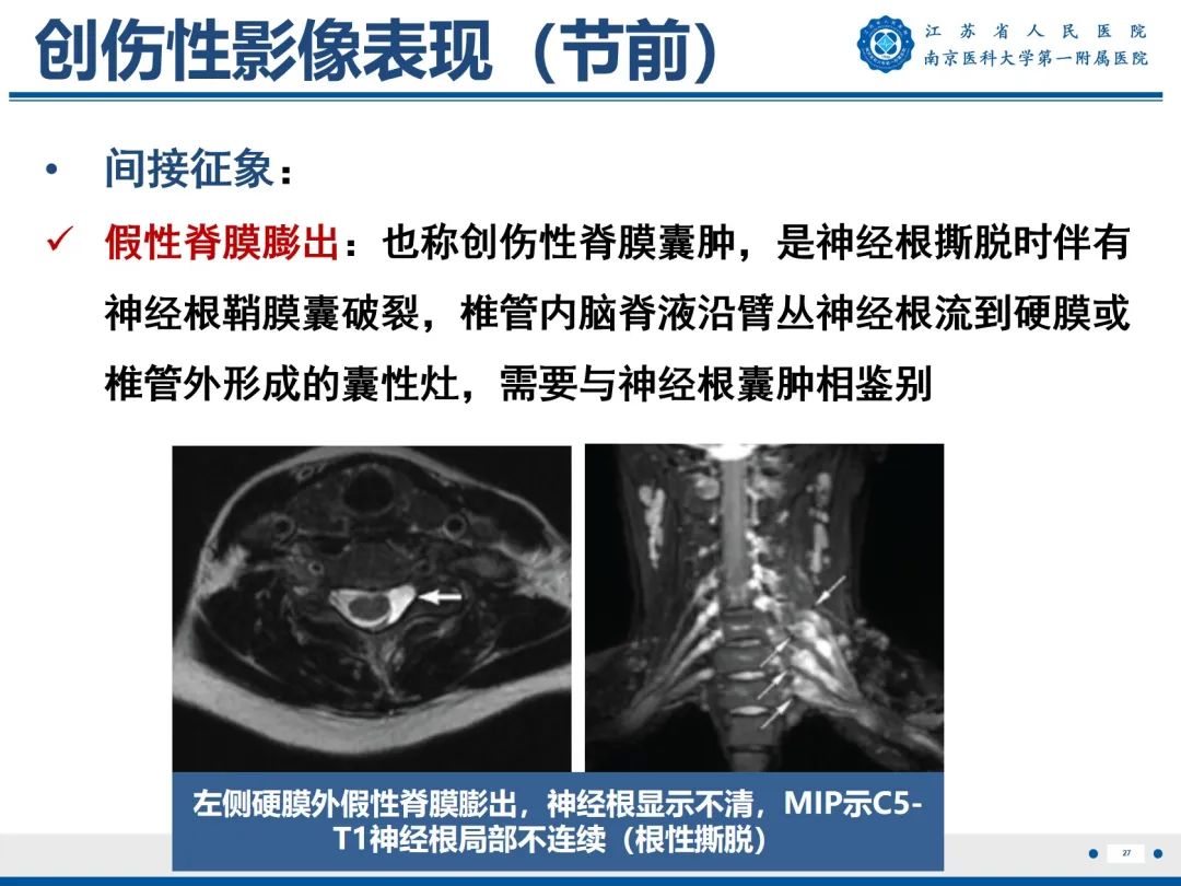【PPT】臂丛病变-28