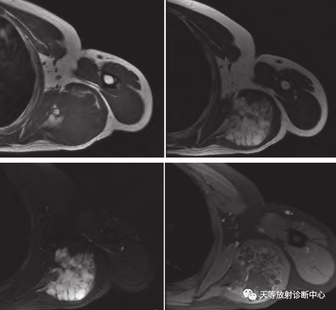 【病例】颈椎脊柱软骨肉瘤1例CT及MR影像-23 【病例】颈椎脊柱软骨肉瘤1例CT及MR影像-23