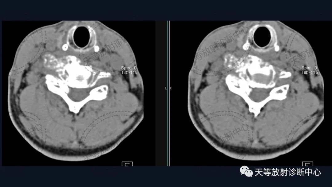 【病例】颈椎脊柱软骨肉瘤1例CT及MR影像-2 【病例】颈椎脊柱软骨肉瘤1例CT及MR影像-2