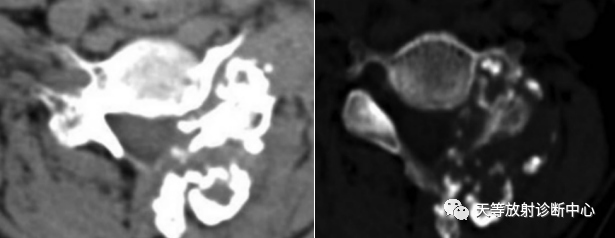 【病例】颈椎脊柱软骨肉瘤1例CT及MR影像-18 【病例】颈椎脊柱软骨肉瘤1例CT及MR影像-18