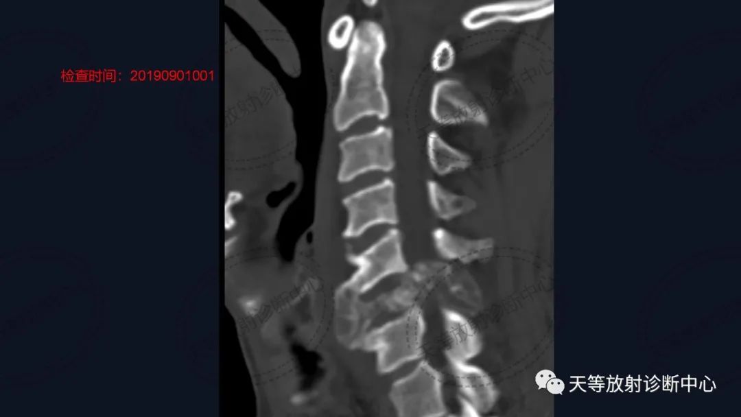 颈椎脊柱软骨肉瘤1例CT及MR影像
