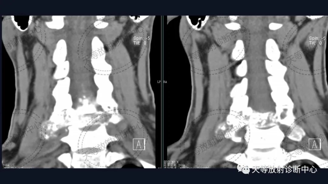 【病例】颈椎脊柱软骨肉瘤1例CT及MR影像-9 【病例】颈椎脊柱软骨肉瘤1例CT及MR影像-9