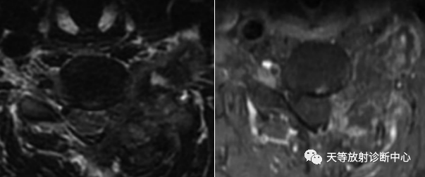 【病例】颈椎脊柱软骨肉瘤1例CT及MR影像-19 【病例】颈椎脊柱软骨肉瘤1例CT及MR影像-19