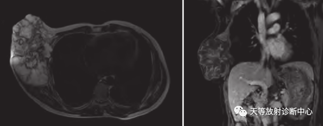 【病例】颈椎脊柱软骨肉瘤1例CT及MR影像-24 【病例】颈椎脊柱软骨肉瘤1例CT及MR影像-24