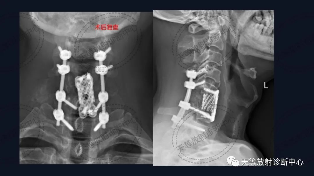 【病例】颈椎脊柱软骨肉瘤1例CT及MR影像-10 【病例】颈椎脊柱软骨肉瘤1例CT及MR影像-10