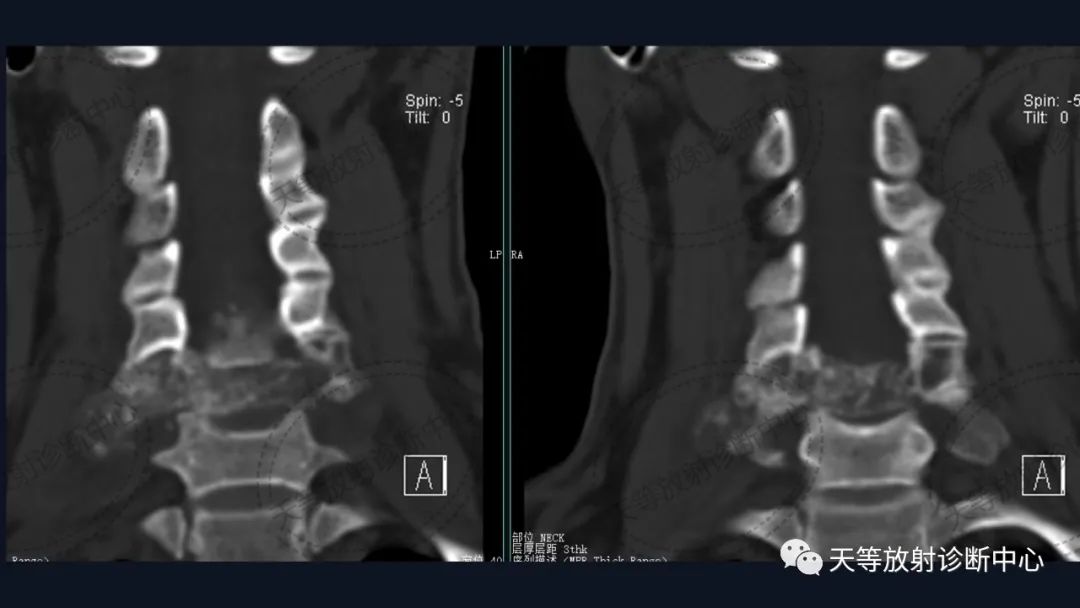 【病例】颈椎脊柱软骨肉瘤1例CT及MR影像-8 【病例】颈椎脊柱软骨肉瘤1例CT及MR影像-8