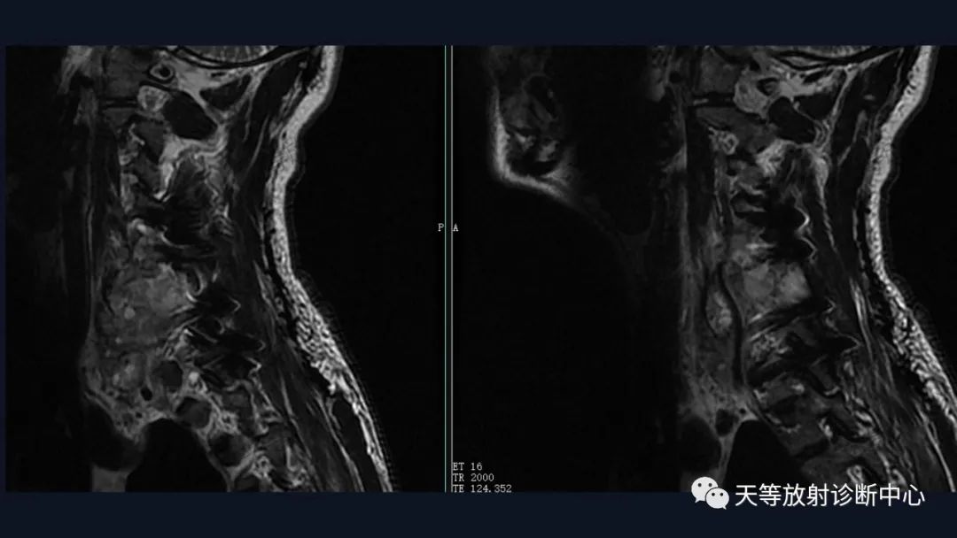 【病例】颈椎脊柱软骨肉瘤1例CT及MR影像-12 【病例】颈椎脊柱软骨肉瘤1例CT及MR影像-12