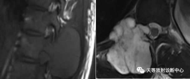 【病例】颈椎脊柱软骨肉瘤1例CT及MR影像-20 【病例】颈椎脊柱软骨肉瘤1例CT及MR影像-20