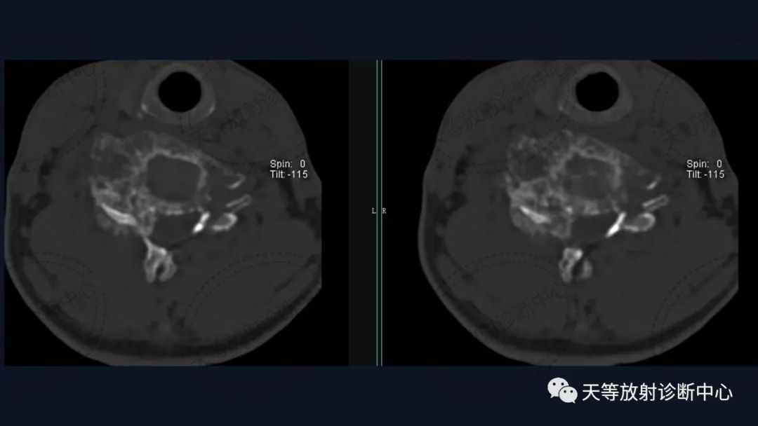 【病例】颈椎脊柱软骨肉瘤1例CT及MR影像-6 【病例】颈椎脊柱软骨肉瘤1例CT及MR影像-6