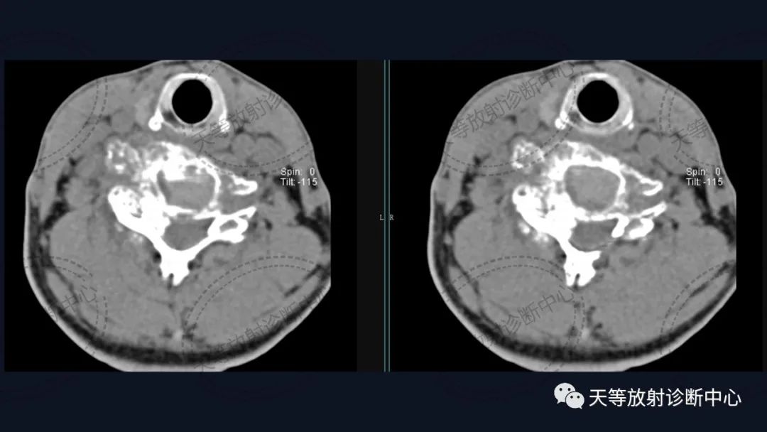 【病例】颈椎脊柱软骨肉瘤1例CT及MR影像-3 【病例】颈椎脊柱软骨肉瘤1例CT及MR影像-3