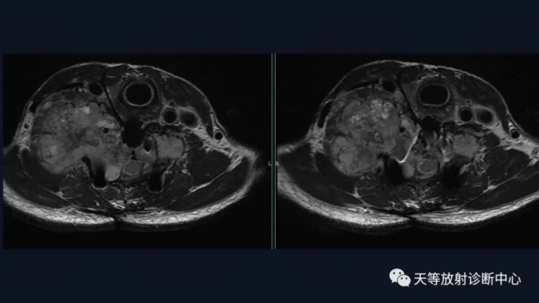 【病例】颈椎脊柱软骨肉瘤1例CT及MR影像-13 【病例】颈椎脊柱软骨肉瘤1例CT及MR影像-13
