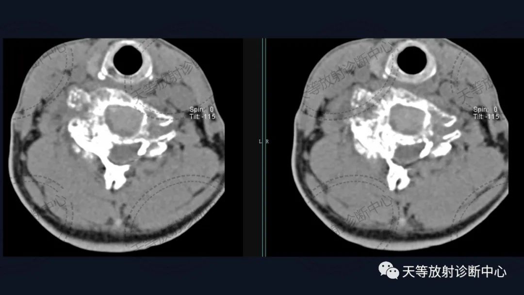 【病例】颈椎脊柱软骨肉瘤1例CT及MR影像-4 【病例】颈椎脊柱软骨肉瘤1例CT及MR影像-4
