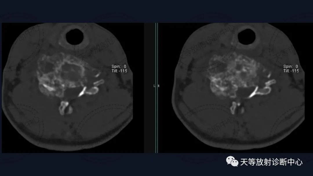 【病例】颈椎脊柱软骨肉瘤1例CT及MR影像-7 【病例】颈椎脊柱软骨肉瘤1例CT及MR影像-7