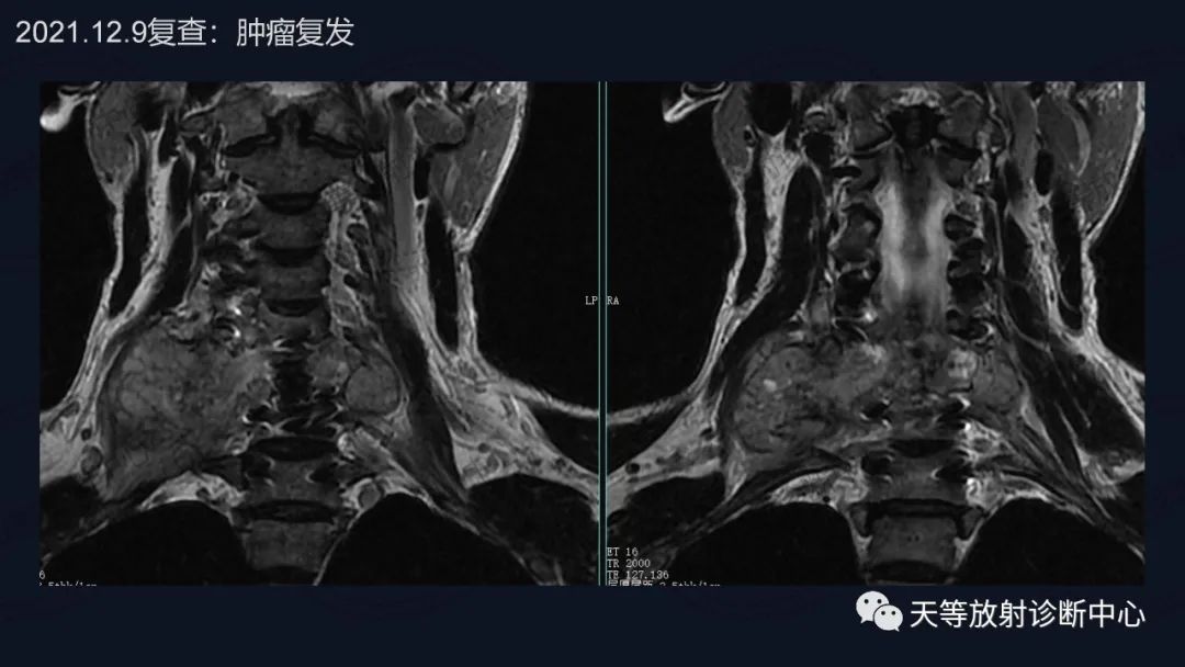 【病例】颈椎脊柱软骨肉瘤1例CT及MR影像-11 【病例】颈椎脊柱软骨肉瘤1例CT及MR影像-11