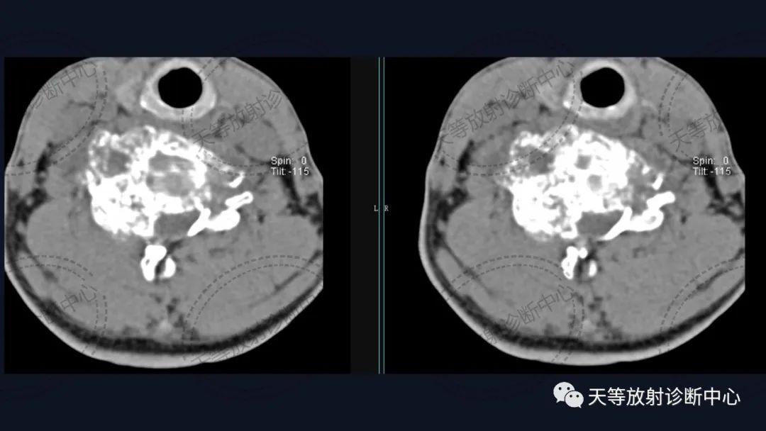 【病例】颈椎脊柱软骨肉瘤1例CT及MR影像-5 【病例】颈椎脊柱软骨肉瘤1例CT及MR影像-5