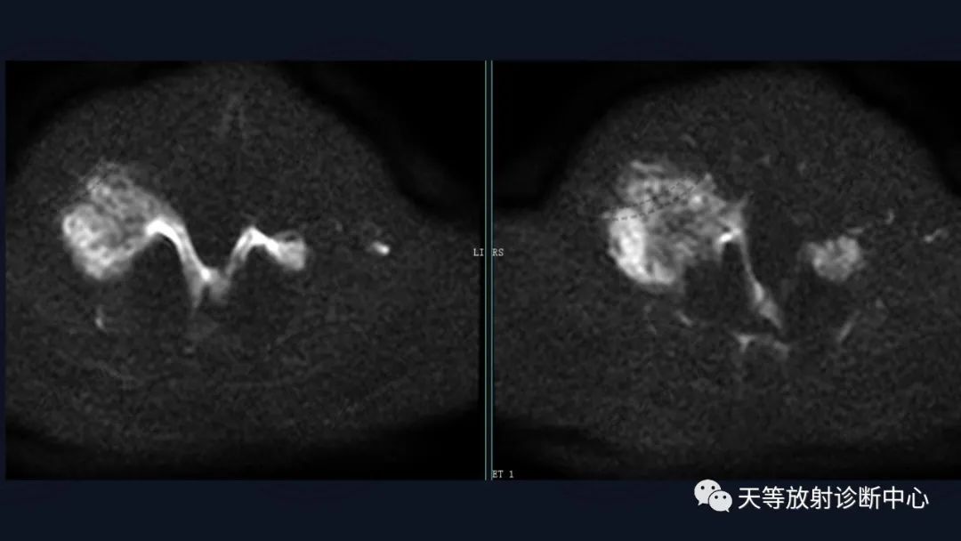 【病例】颈椎脊柱软骨肉瘤1例CT及MR影像-14 【病例】颈椎脊柱软骨肉瘤1例CT及MR影像-14