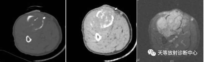 【病例】颈椎脊柱软骨肉瘤1例CT及MR影像-22 【病例】颈椎脊柱软骨肉瘤1例CT及MR影像-22