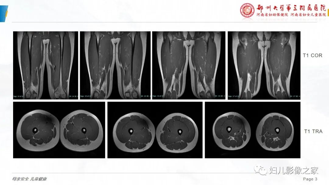 【病例】横纹肌溶解症1例MR影像-3