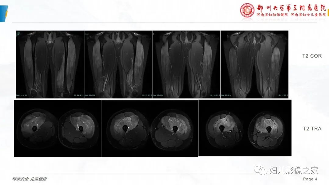 【病例】横纹肌溶解症1例MR影像-4
