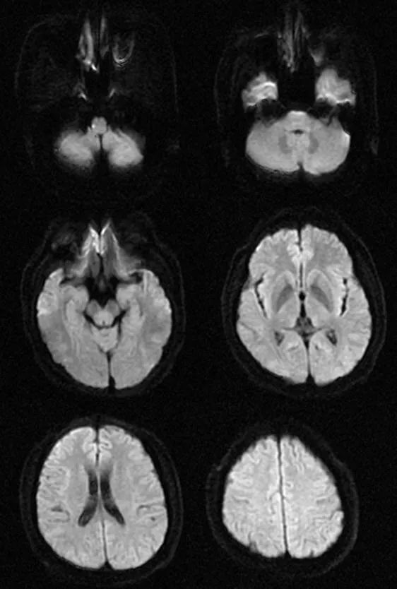 【病例】肢体麻木，定位可千万别漏掉这个地方-6