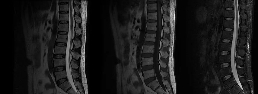 【病例】肢体麻木，定位可千万别漏掉这个地方-2