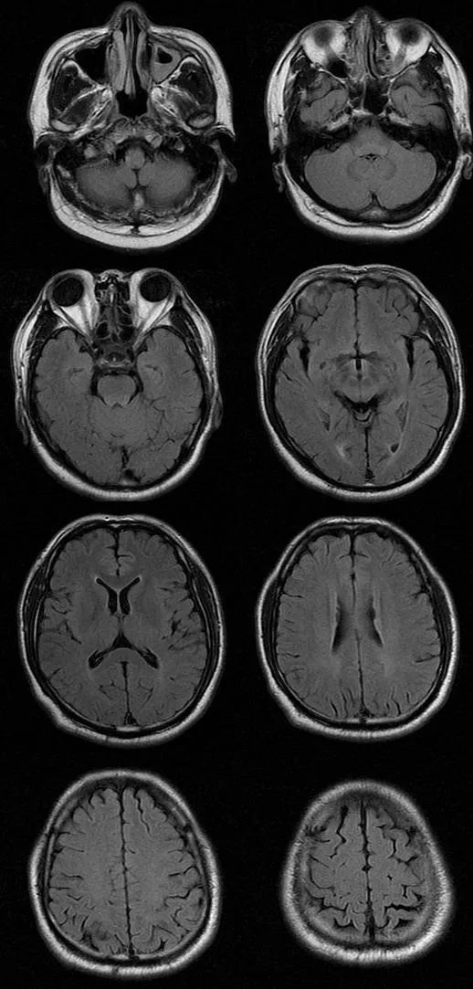 【病例】肢体麻木，定位可千万别漏掉这个地方-5