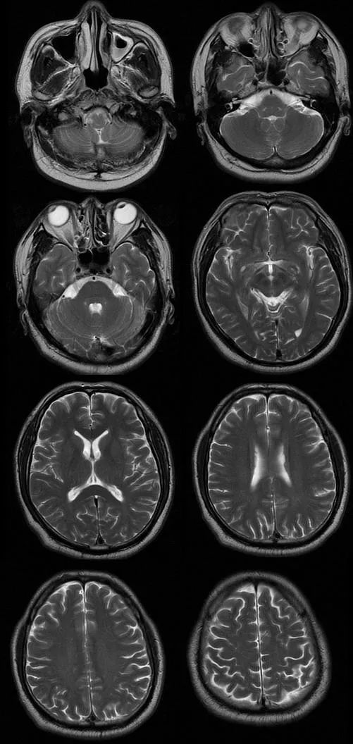 【病例】肢体麻木，定位可千万别漏掉这个地方-4