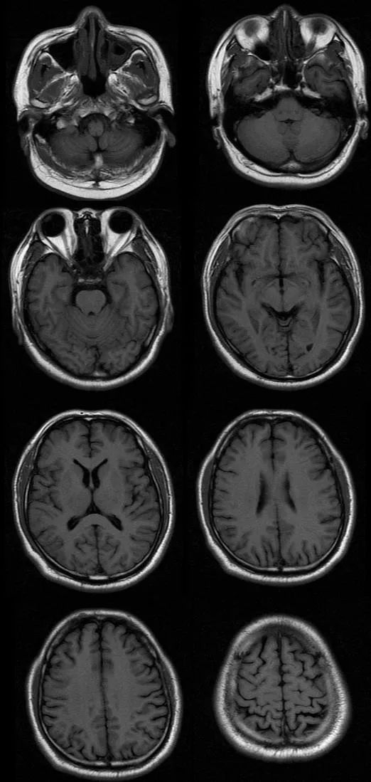 【病例】肢体麻木，定位可千万别漏掉这个地方-3