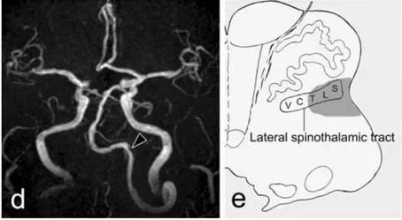 【病例】肢体麻木，定位可千万别漏掉这个地方-9