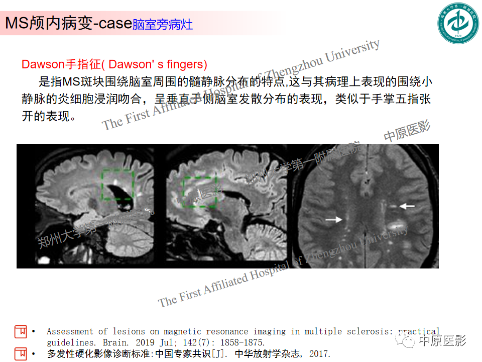 【PPT】视神经脊髓炎与多发性硬化鉴别诊断-35
