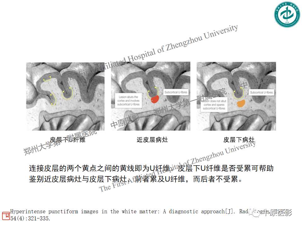 【PPT】视神经脊髓炎与多发性硬化鉴别诊断-32