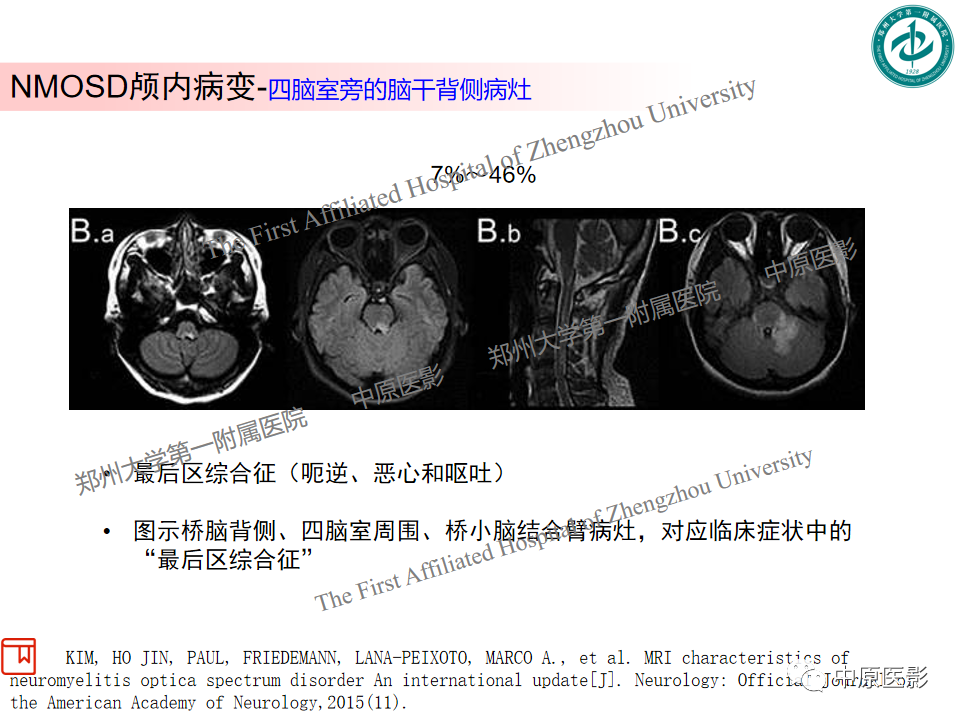 【PPT】视神经脊髓炎与多发性硬化鉴别诊断-10