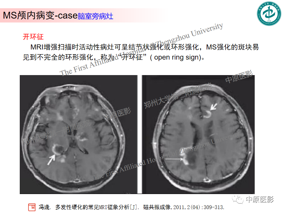 【PPT】视神经脊髓炎与多发性硬化鉴别诊断-39