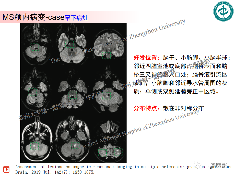 【PPT】视神经脊髓炎与多发性硬化鉴别诊断-42