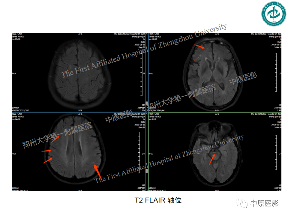 【PPT】视神经脊髓炎与多发性硬化鉴别诊断-51