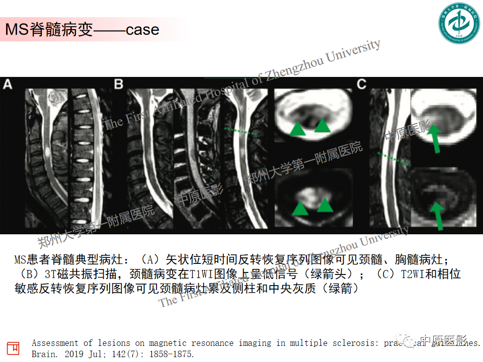 【PPT】视神经脊髓炎与多发性硬化鉴别诊断-28