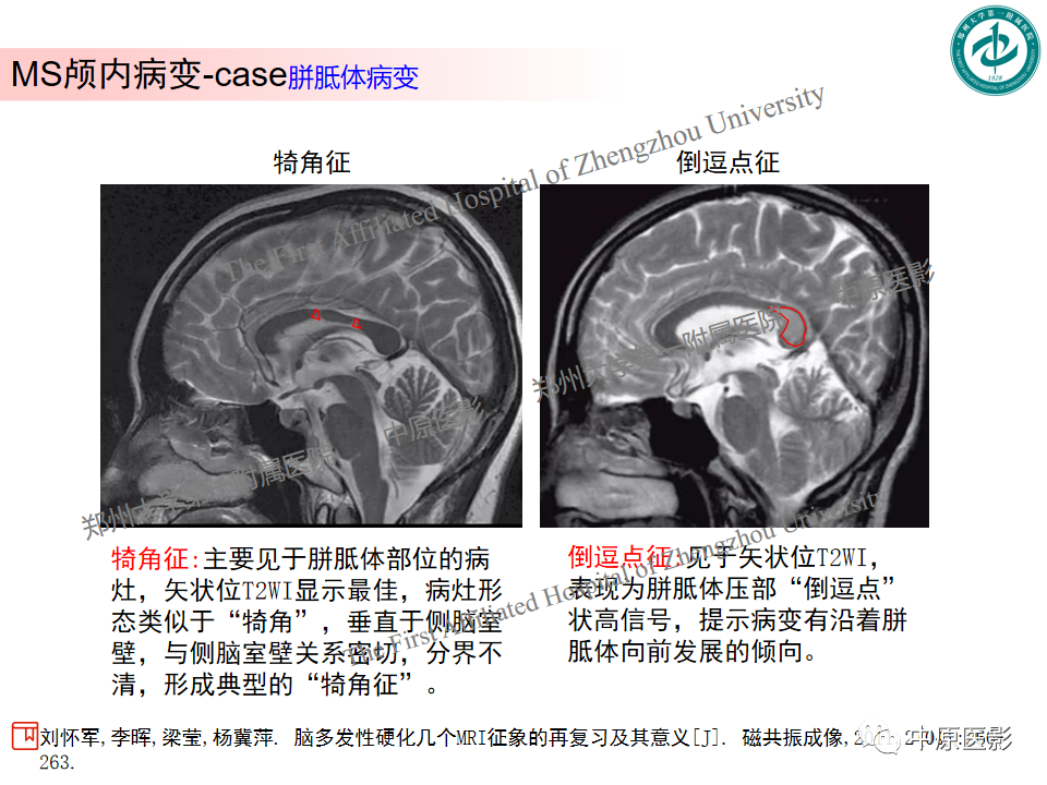 【PPT】视神经脊髓炎与多发性硬化鉴别诊断-40