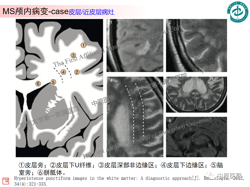 【PPT】视神经脊髓炎与多发性硬化鉴别诊断-31