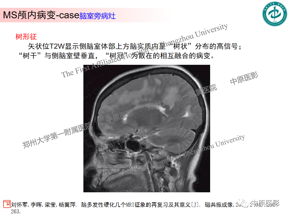 【PPT】视神经脊髓炎与多发性硬化鉴别诊断-37