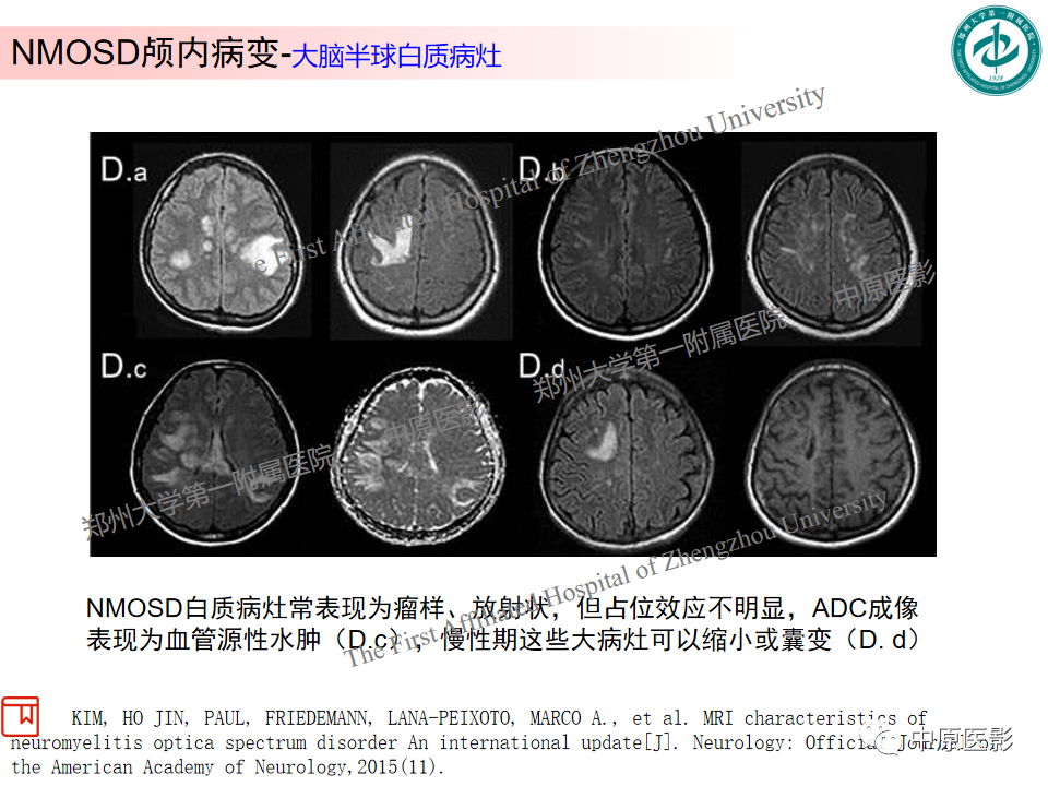 【PPT】视神经脊髓炎与多发性硬化鉴别诊断-12