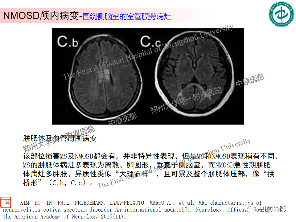 【PPT】视神经脊髓炎与多发性硬化鉴别诊断-11