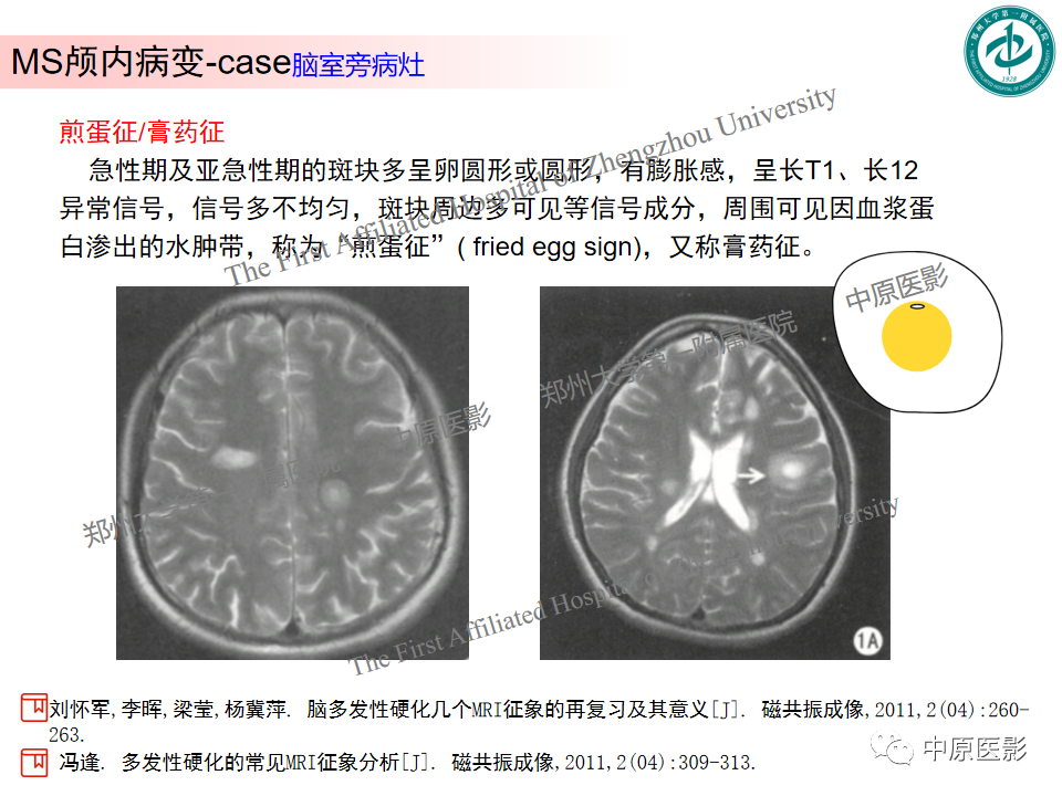 【PPT】视神经脊髓炎与多发性硬化鉴别诊断-36